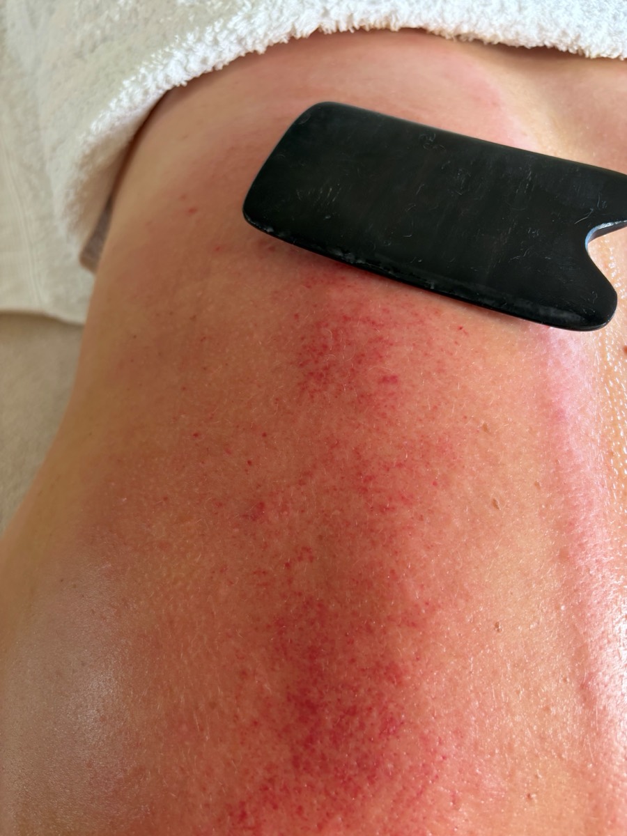 Gua-Sha-Behandlung mit einem Schaber auf der Haut
